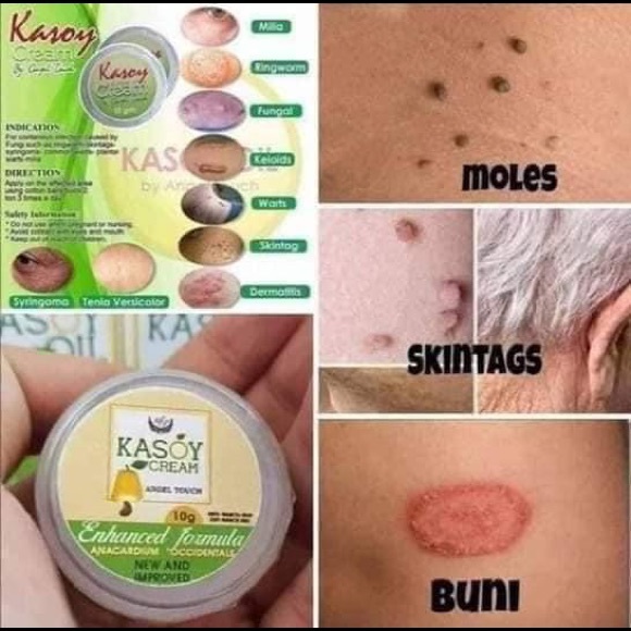 Kasoy Cream by Angel Touch skin tag keloid milia - Picture 3 of 9